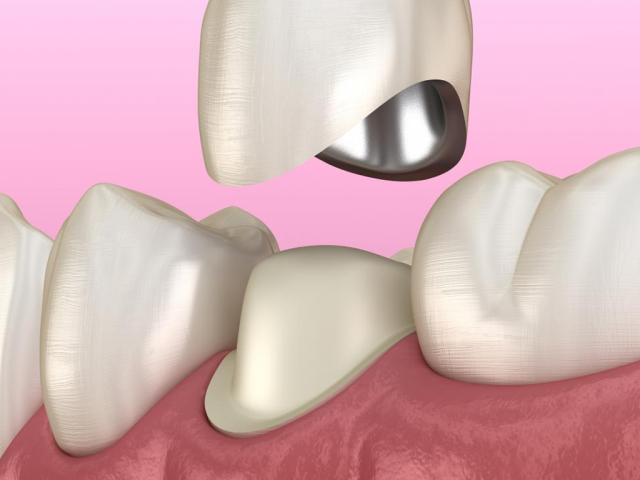 Dental Crown