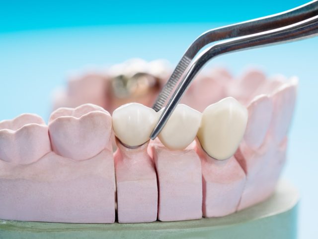 Dental Bridges