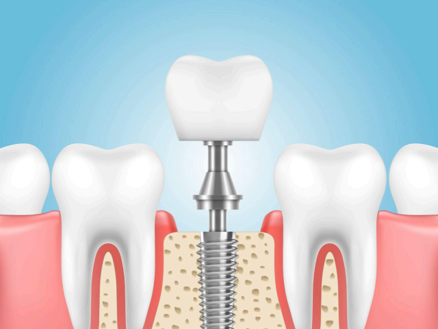 Dental Implant
