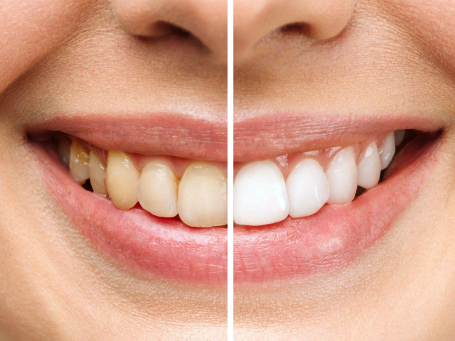 Teeth Whitening