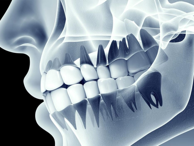 Dental X-ray