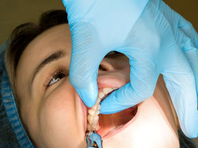 Wisdom Tooth Removal